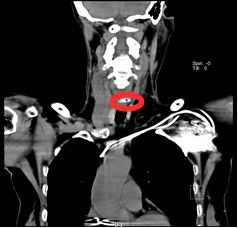 枣核卡喉有多危险?中大医院专家教你三步救命法