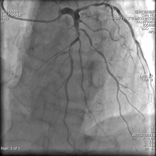 攻坚「钙化堡垒」！湖北省三院阳逻院区成功实施高难度冠脉手术，为七旬老人重铸「心」路