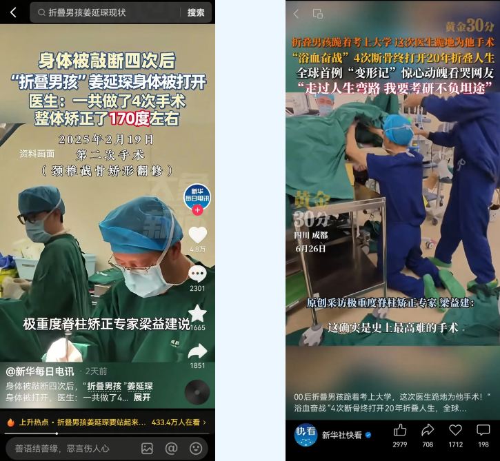 全网播放量数亿！成都京东方医院完成世界首例反向折叠人矫正手术