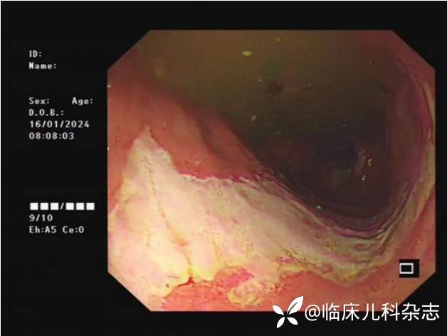 火眼辨症·第 7 期丨女童腹痛反复发作，怎么诊治？