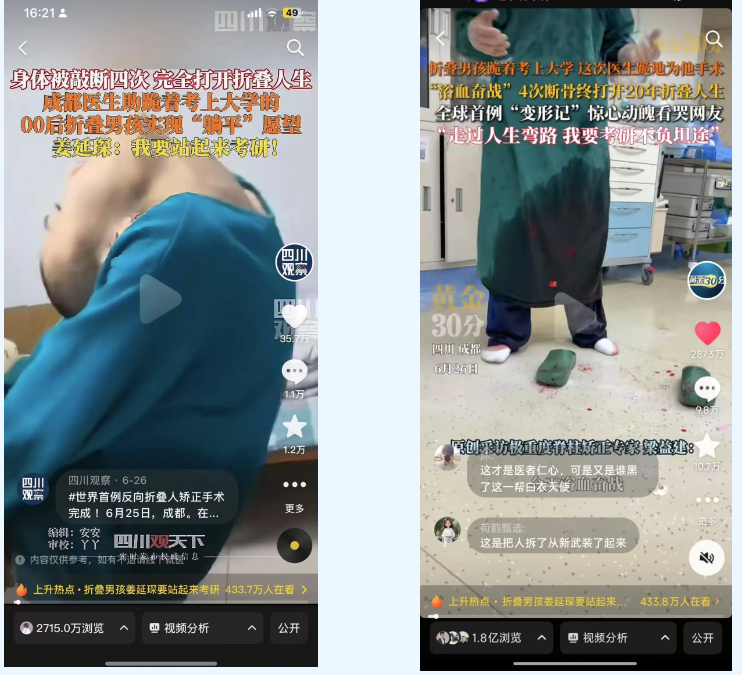 全网播放量数亿！成都京东方医院完成世界首例反向折叠人矫正手术
