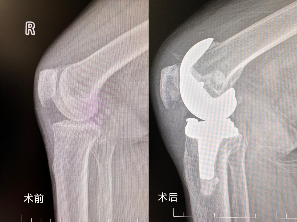 50 岁大伯膝盖磨光痛到「叫」!湖南妇女儿童医院关节置换助其换膝