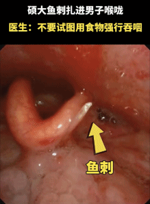 异物卡喉别乱来，这一动作学会能救命！拍背、喝醋反误事