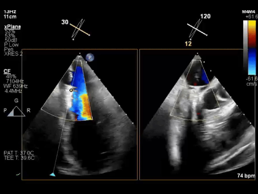医保新政落地!心脏瓣膜手术费用大降,1 cm 切口就能换「心门」