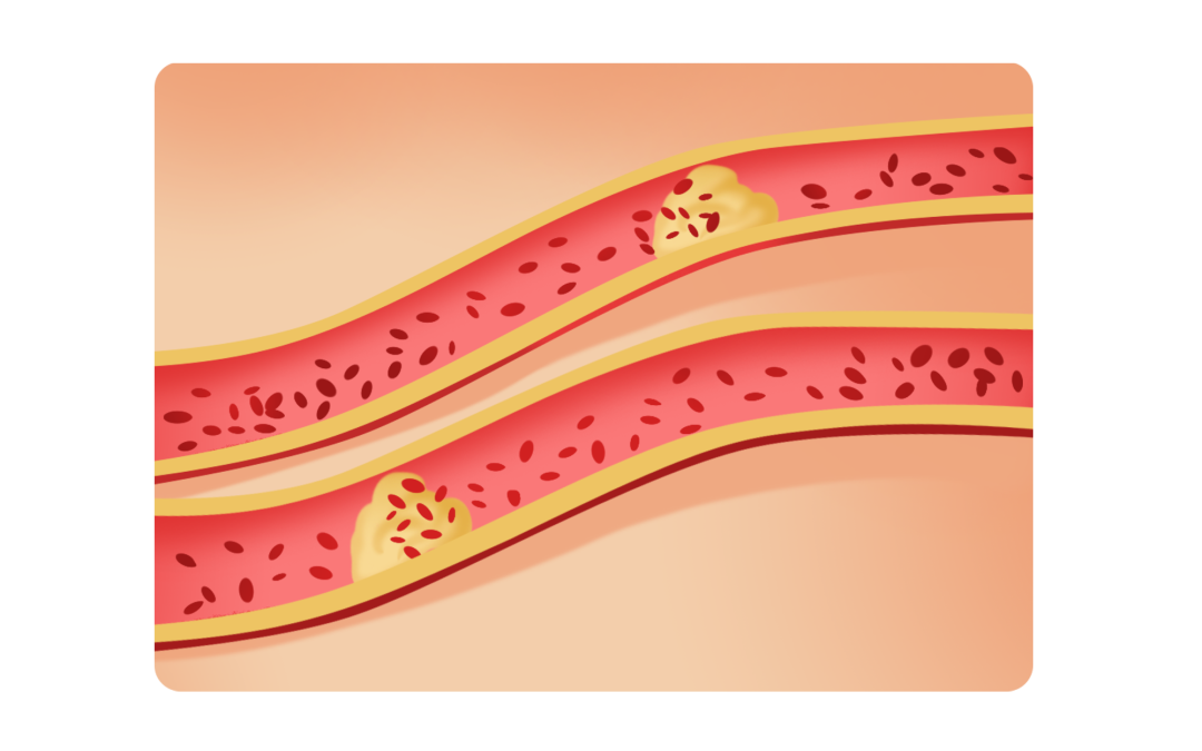 新型降脂药——PCSK9 抑制剂