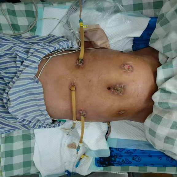 再遇危险「节日病」——重症急性胰腺炎,MDT 协作攻坚勇闯「生死关」!