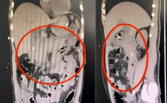 再遇危险「节日病」——重症急性胰腺炎,MDT 协作攻坚勇闯「生死关」!
