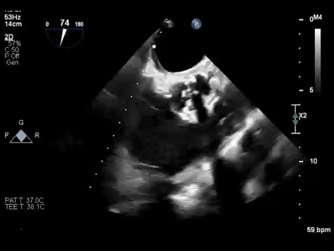 医保新政落地!心脏瓣膜手术费用大降,1 cm 切口就能换「心门」