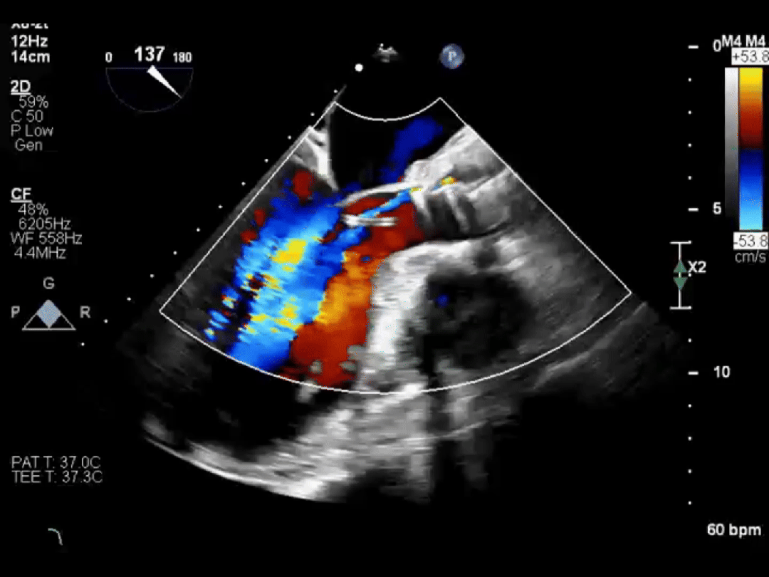医保新政落地!心脏瓣膜手术费用大降,1 cm 切口就能换「心门」
