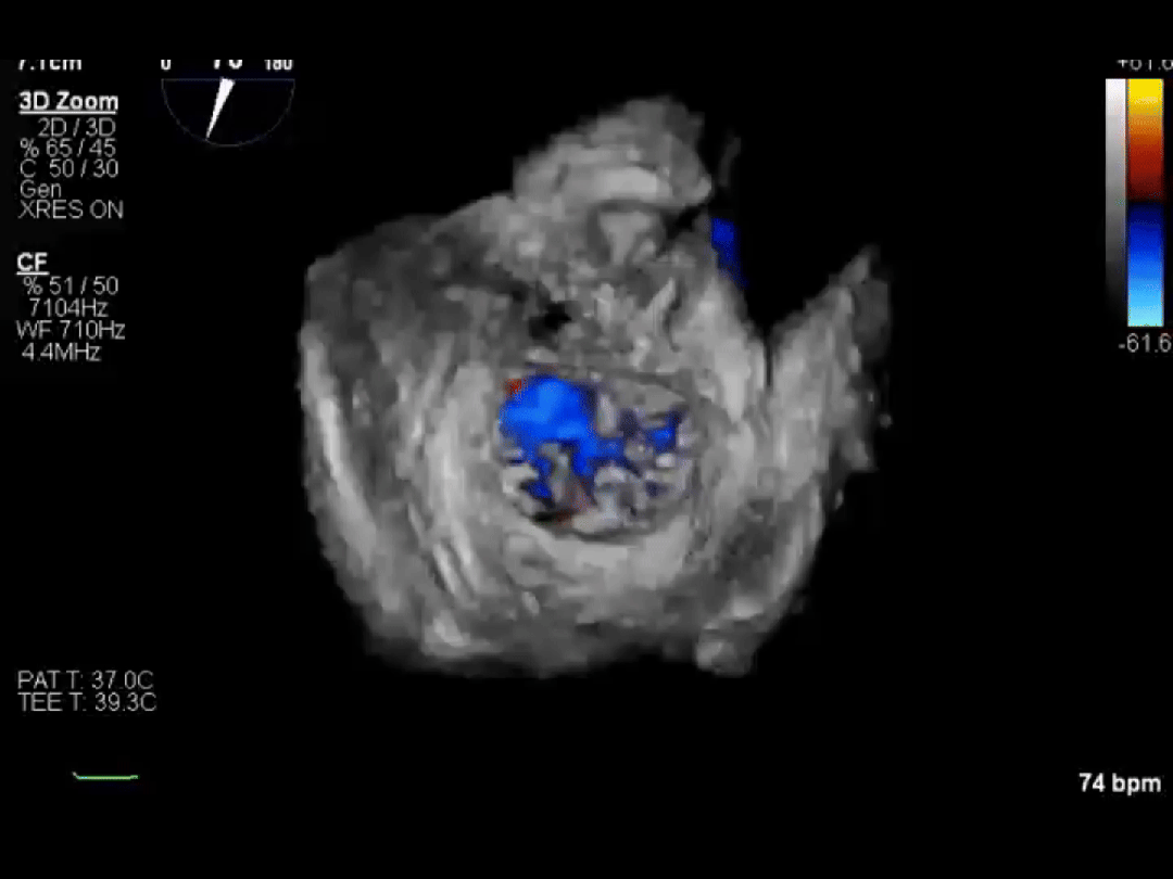 医保新政落地!心脏瓣膜手术费用大降,1 cm 切口就能换「心门」