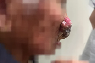 九旬老太脸上长「核桃」！ 表皮囊肿莫轻视