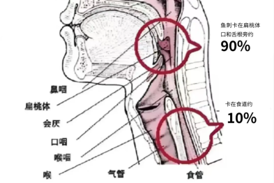 喉咙异物感难耐，竟是发丝舌根「打结」！苏州明基医院耳鼻喉科夜门诊解患者之痛