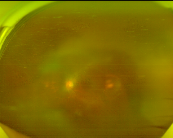 西藏患者千里求医！爱尔专家重塑眼内微观世界实现视力逆袭