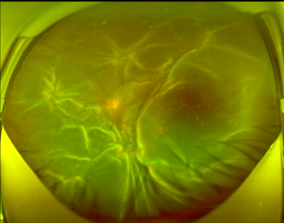 西藏患者千里求医！爱尔专家重塑眼内微观世界实现视力逆袭