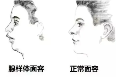 暑期青少年耳鼻喉健康指南：别让「小毛病」拖成大问题