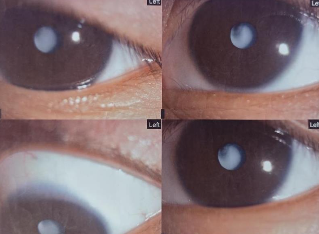 男童因先天性白内障险失明 武汉普瑞眼科程旭康手术除障保其视力