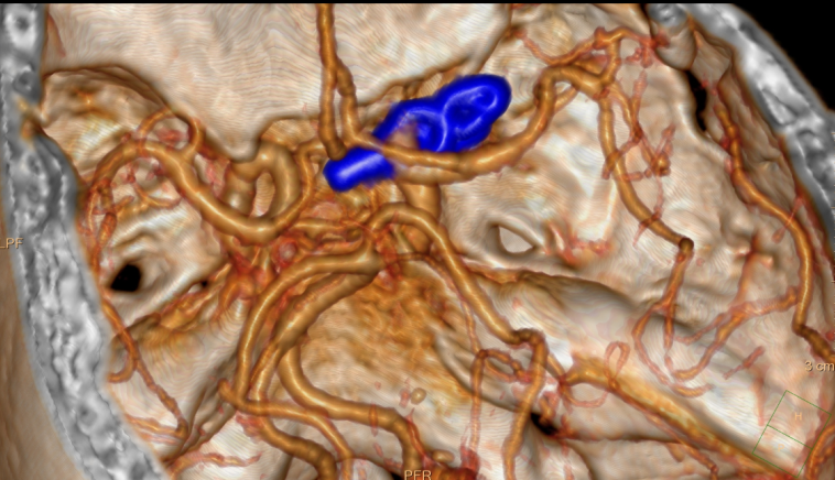 七旬老人颅内惊现"双胞胎炸弹"，医生用"钥匙孔"手术力挽狂澜
