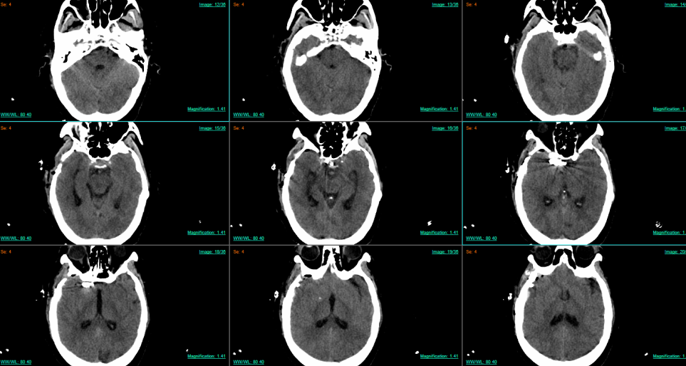 七旬老人颅内惊现"双胞胎炸弹"，医生用"钥匙孔"手术力挽狂澜