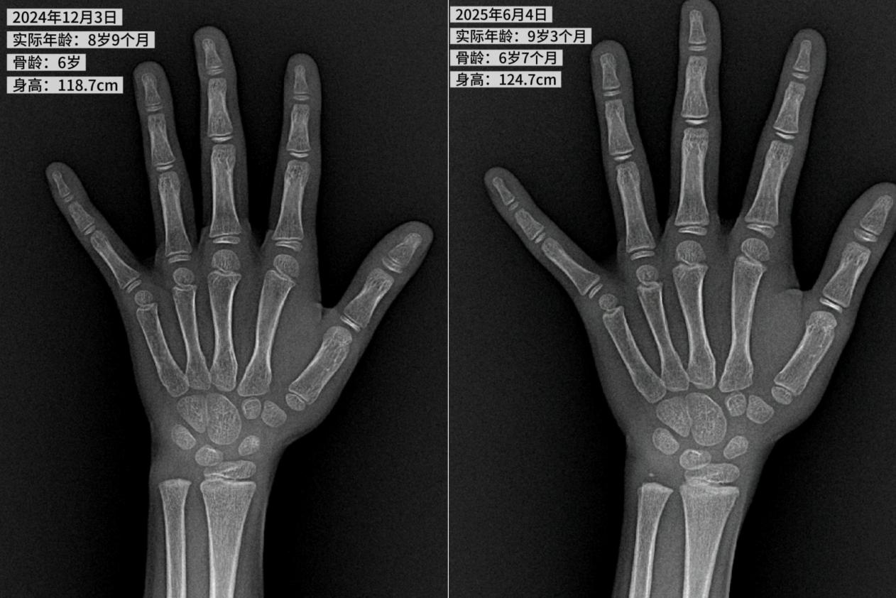 父母高≠孩子高！8 岁 9 个月女孩身高比同龄人矮了 14 cm