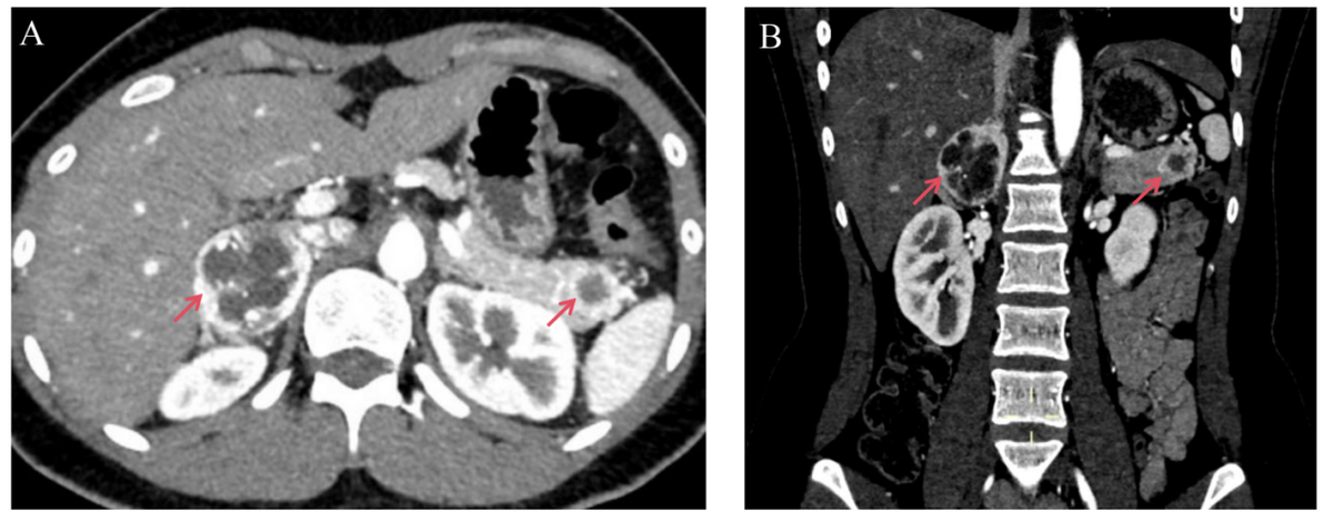 南昌大学二附院多学科协作破解 18 岁少女罕见高血压之谜 精准诊疗创造生命奇迹