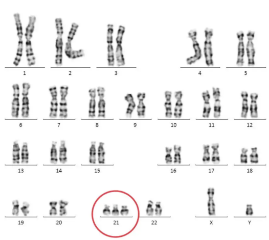 不打麻药做羊穿，一根长针直穿肚皮？揭开羊水穿刺的神秘面纱