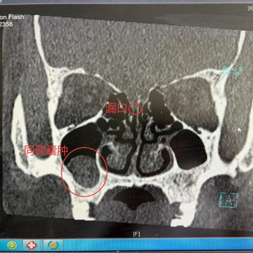 清水鼻涕流不停,一查竟是脑脊液!