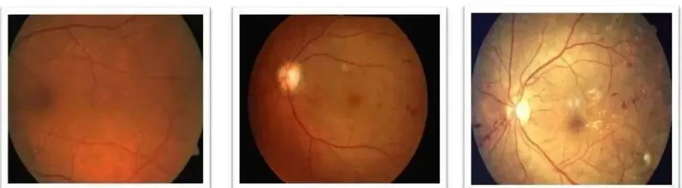 糖尿病视网膜病变能治好吗？武汉普瑞眼科许泽骏提醒早发现早治疗