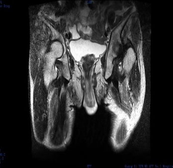 肛门肿物难以回纳，难言之隐困扰三年——微创托起「失控的直肠」！