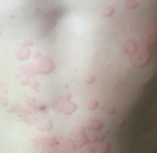 【世界过敏性疾病日】小龙虾配啤酒 ，肿成「红胖子」？紧急提醒：过敏人群要谨慎