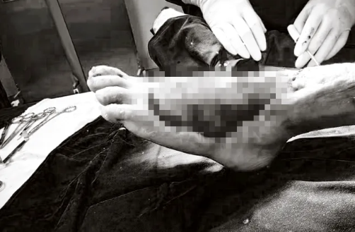 精细治疗保住受伤左足 蓟医团队书写抢救奇迹