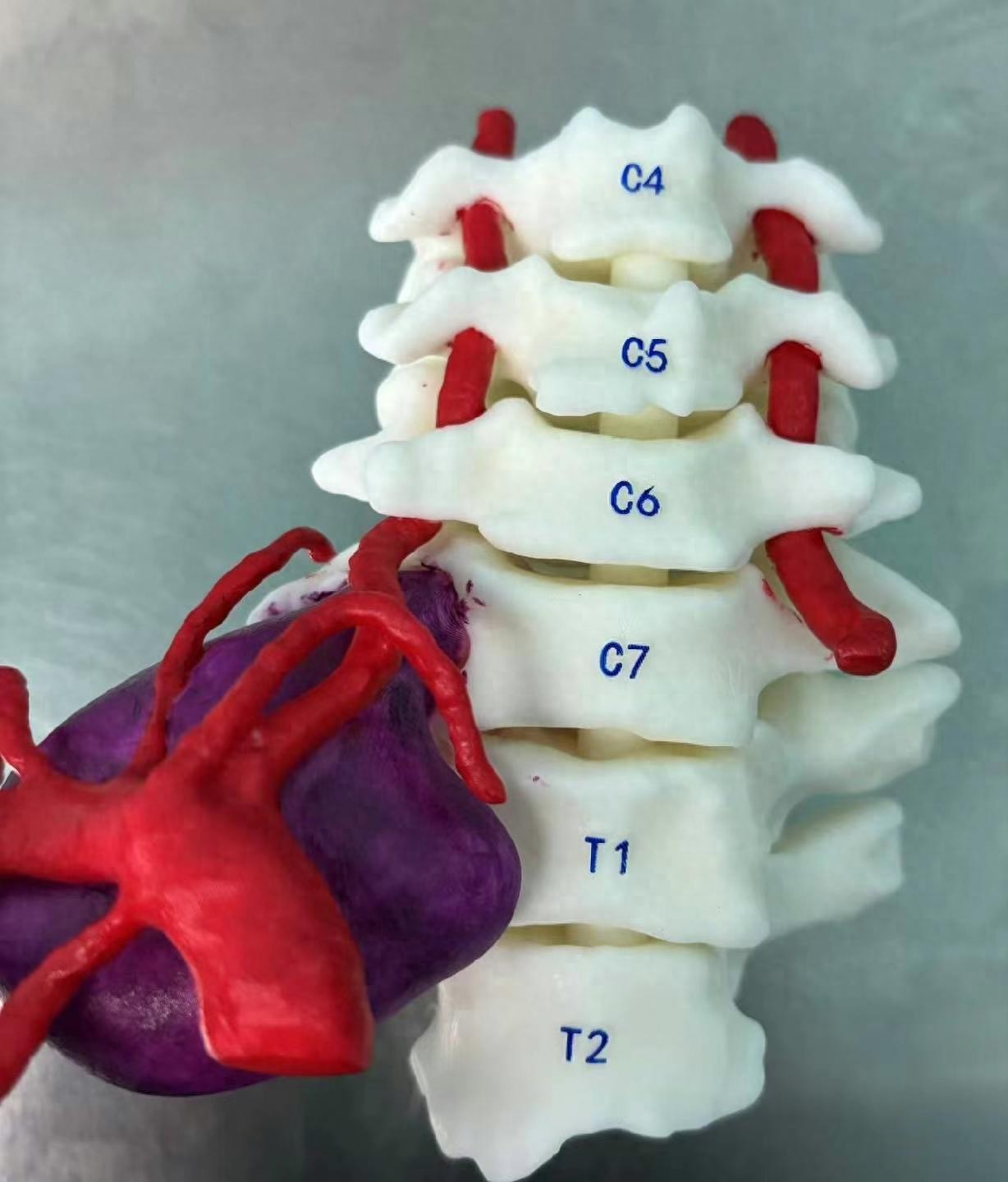 「江陵-武汉」转诊接力 武大人民医院专家巧除颈脊髓深部肿瘤