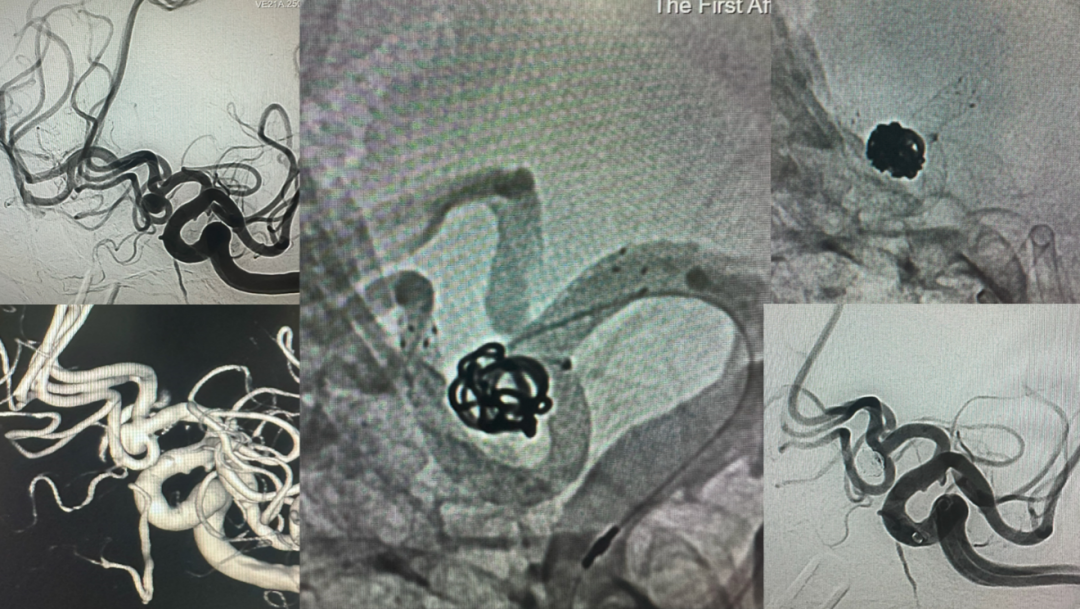 西交大一附院神经内科成功完成西北首例 LVIS EVO 支架辅助治疗颅内动脉瘤