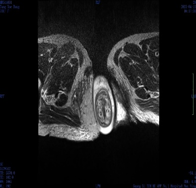 肛门肿物难以回纳，难言之隐困扰三年——微创托起「失控的直肠」！