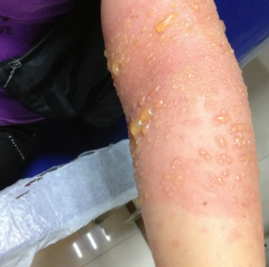 【世界过敏性疾病日】小龙虾配啤酒 ，肿成「红胖子」？紧急提醒：过敏人群要谨慎