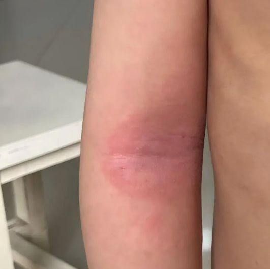 【世界过敏性疾病日】小龙虾配啤酒 ，肿成「红胖子」？紧急提醒：过敏人群要谨慎