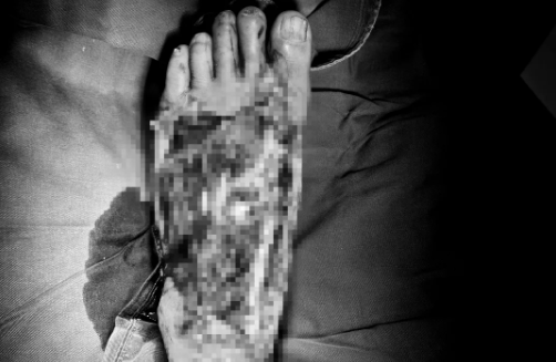 精细治疗保住受伤左足 蓟医团队书写抢救奇迹