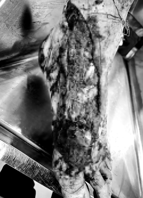 精细治疗保住受伤左足 蓟医团队书写抢救奇迹