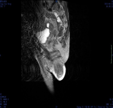 肛门肿物难以回纳，难言之隐困扰三年——微创托起「失控的直肠」！