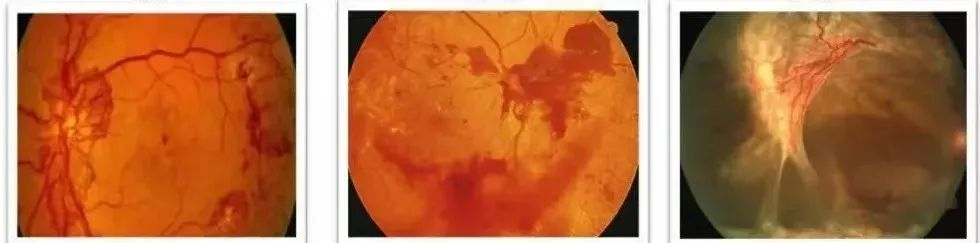 糖尿病视网膜病变能治好吗？武汉普瑞眼科许泽骏提醒早发现早治疗