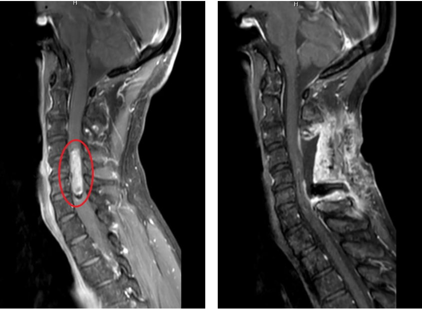 从 「治愈或致残」 到重获新生：四川蓝生脑科医院神经导航技术破解颈髓肿瘤难题