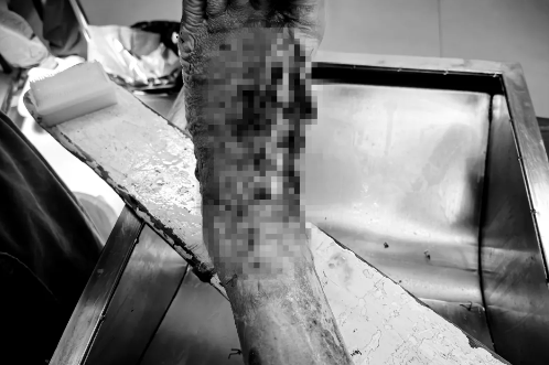 精细治疗保住受伤左足 蓟医团队书写抢救奇迹