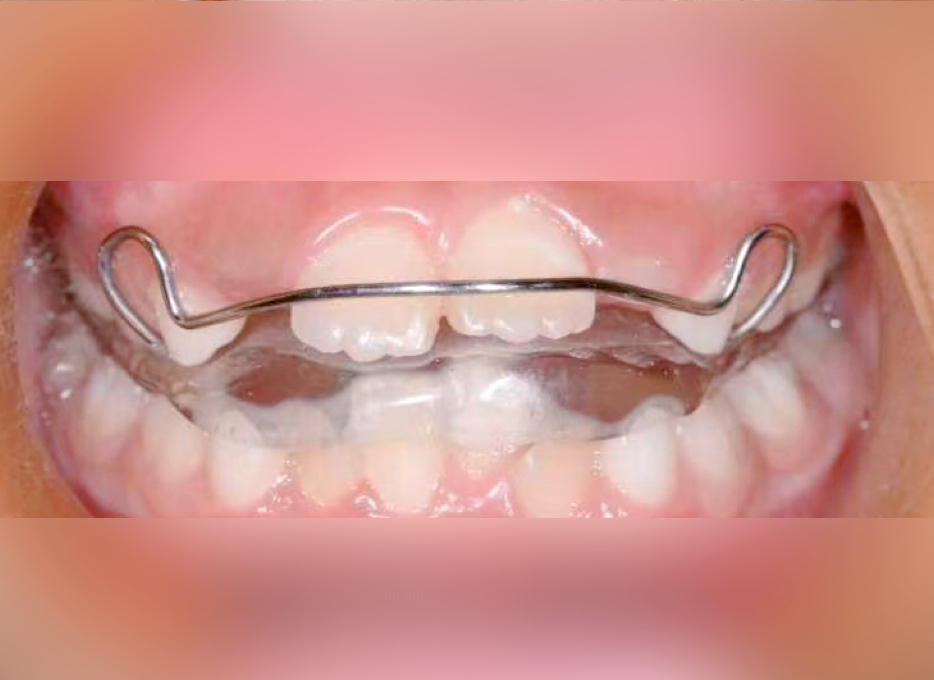 8 岁女孩暑期矫正实录:别让孩子「变丑又变笨」成现实