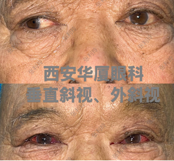 无声世界里的光明守护——西安华厦眼科助 77 岁聋哑老人告别 18 年复视困扰