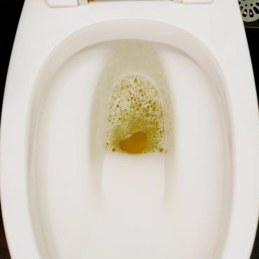 特聘专家杨晓教授带领肾病内科团队成功救治危重肾病综合征患者