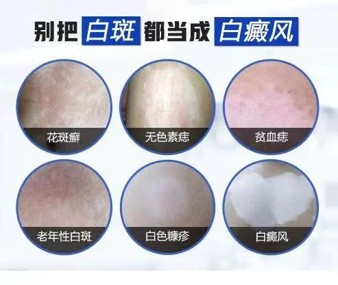【二附院医生说】白癜风：皮肤上的「白色谜团」