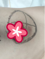 乳房肿痛、双腿差点走不动路…从迷茫到希望,她走出了「肉芽肿性乳腺炎」阴霾