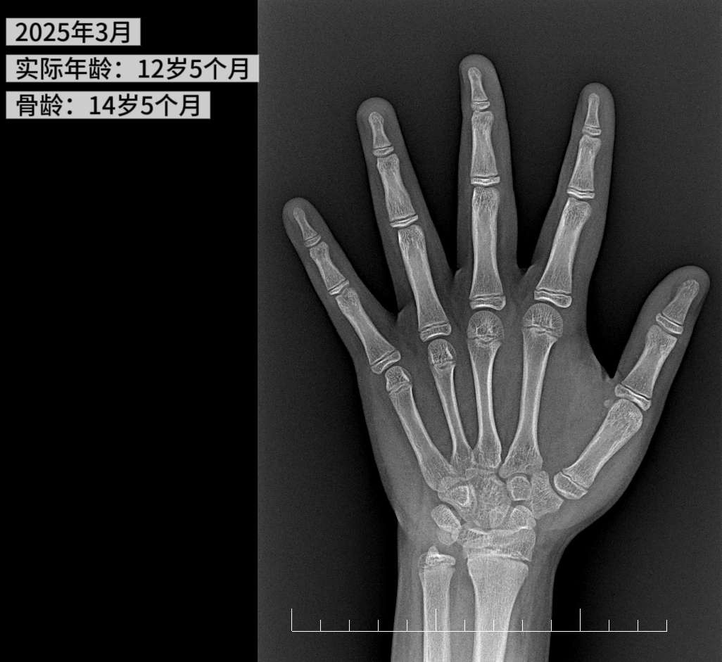 12.5 岁男孩体重高达 180 斤，多项指标亮红灯！