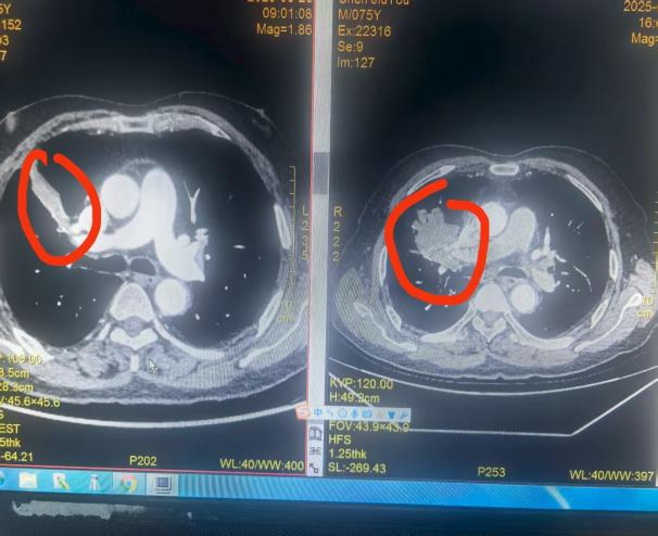 肺癌中晚期+转移≠绝望，桂医二附院一套「组合拳」让癌症变慢病