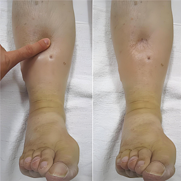 特聘专家杨晓教授带领肾病内科团队成功救治危重肾病综合征患者