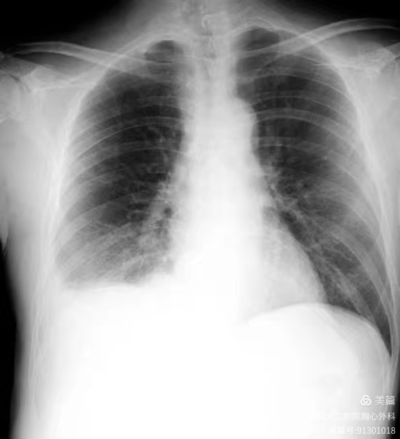 食管突遭「爆雷」,一场鱼汤引发的健康危机!医生紧急提醒毕业季聚餐风险